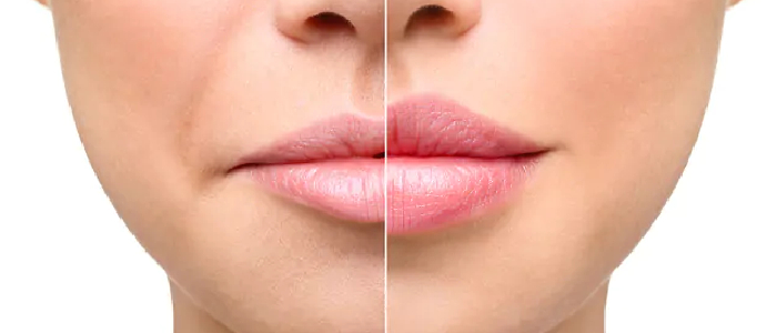dermal-fillers
