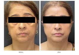 Instant Face Lift