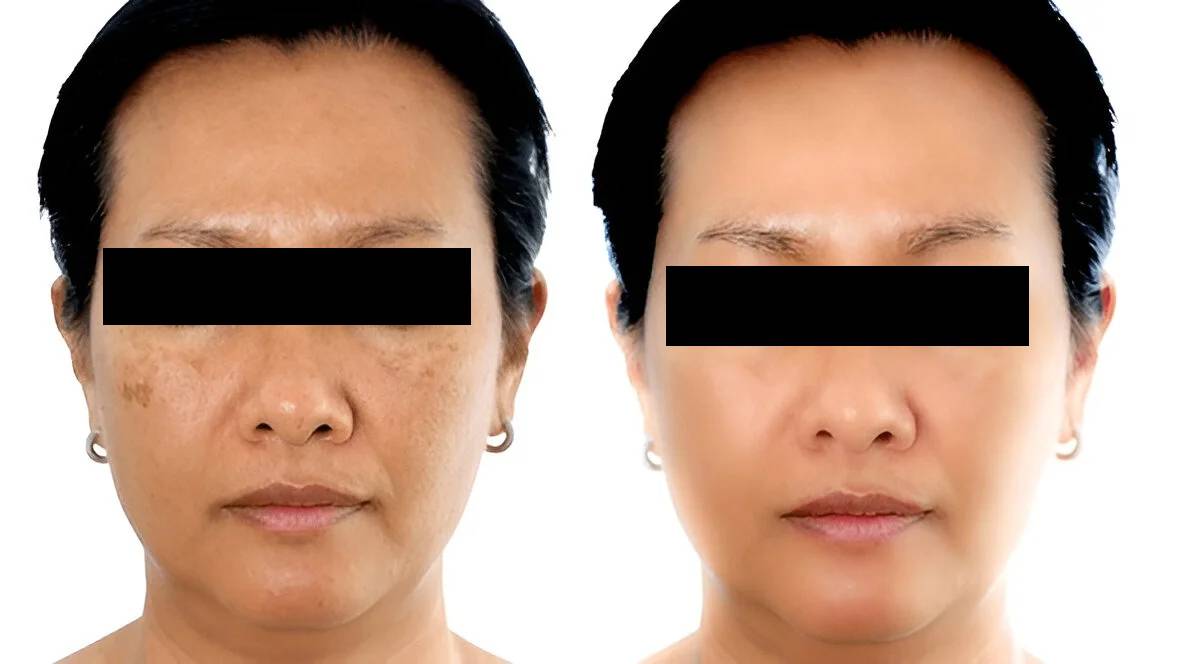 Pigment Reduction